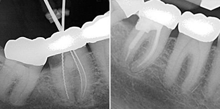 Karies unter der Krone (links) / Zahnkronenrettung durch einen geklebten Titanstift (rechts)